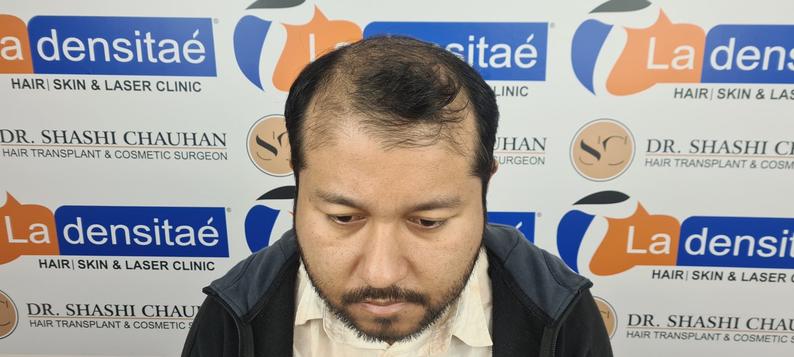 Dr. Bishal Before Hair Transplant